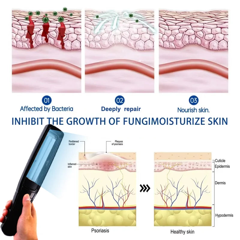 311nm Ultraviolet Phototherapy Instrument Use UVB Lamp UV for Vitiligo Psoriasis White Spots Skin Disease